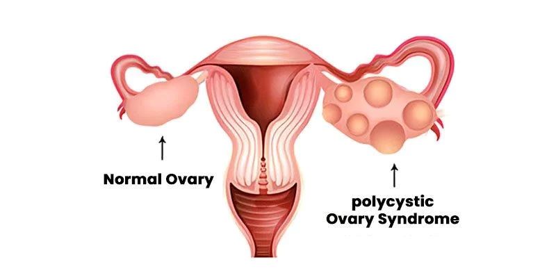 PCOS and Fertility 