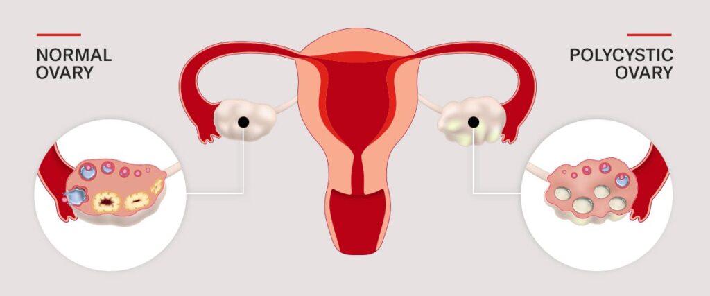 pcod meaning and symptoms